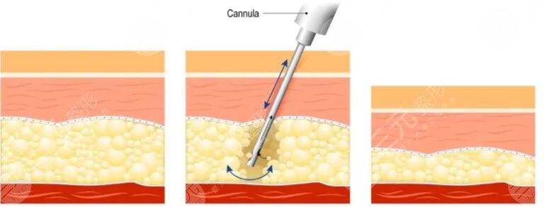 吸脂減肥的優(yōu)點(diǎn)