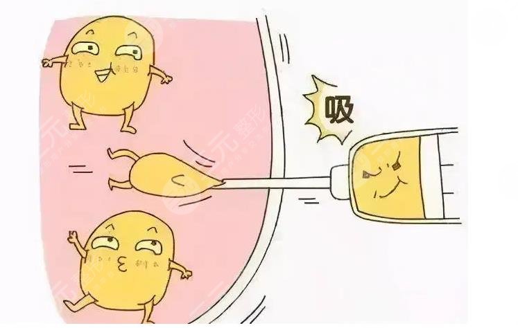 腹部吸脂肪有什么后遺癥?