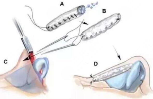 隆鼻需要多長時(shí)間恢復(fù)?