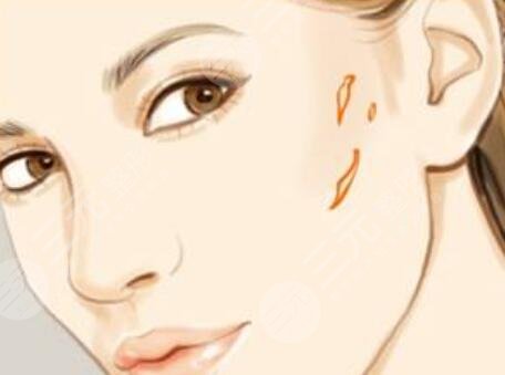 激光去切痣疤痕