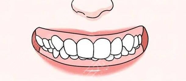 深覆合一定要做矯正嗎？深覆合矯正前后臉型對比圖|合適的年紀(jì)是多久？