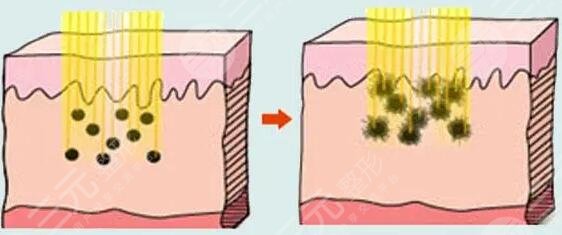 點陣激光緩解痘坑會反彈復發(fā)嗎?