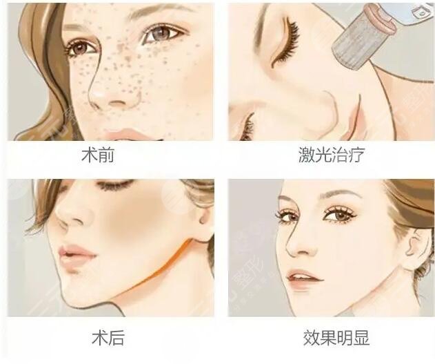 點陣激光祛痘坑術后注意事項