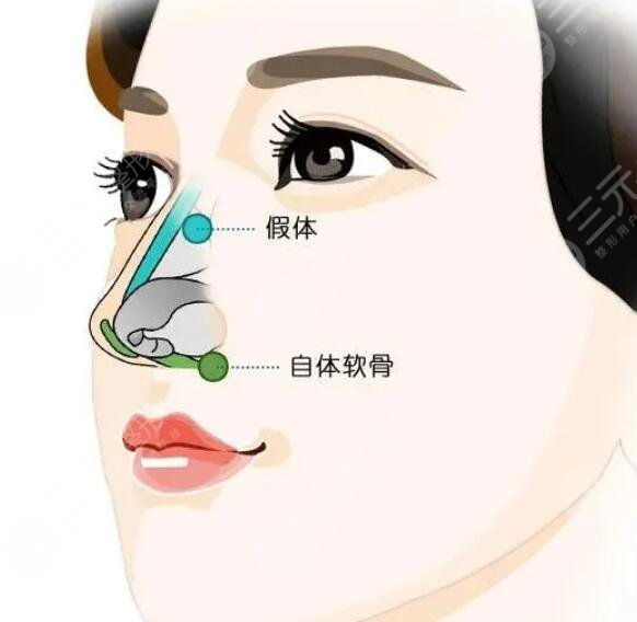 膨體材料隆鼻多少錢2023新版，手術(shù)材料的優(yōu)缺點解析、術(shù)后護理小貼士~