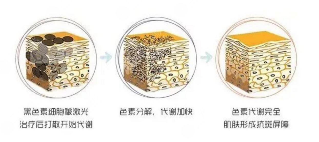 激光祛斑的效果