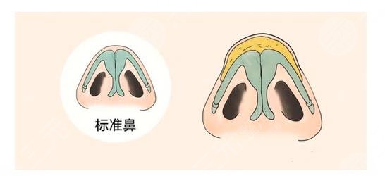 縮鼻翼和鼻頭多少錢?