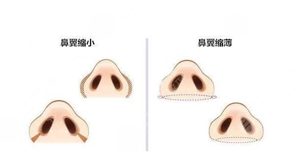 縮鼻翼和鼻頭多少錢?