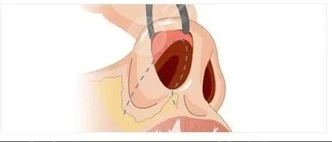 縮鼻翼和鼻頭多少錢?