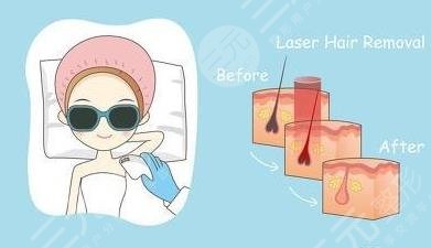 光子脫毛的危害