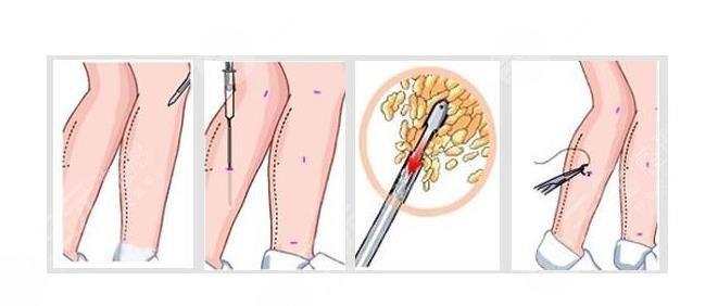 預(yù)防小腿變粗的注意事項
