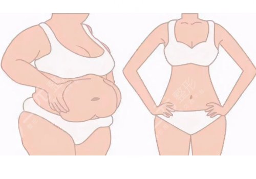 北京新星靚李偉民吸脂怎么樣?