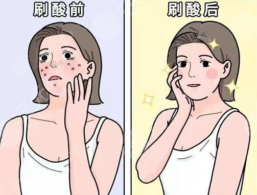 去除痘痘之后多長(zhǎng)時(shí)間可以恢復(fù)?