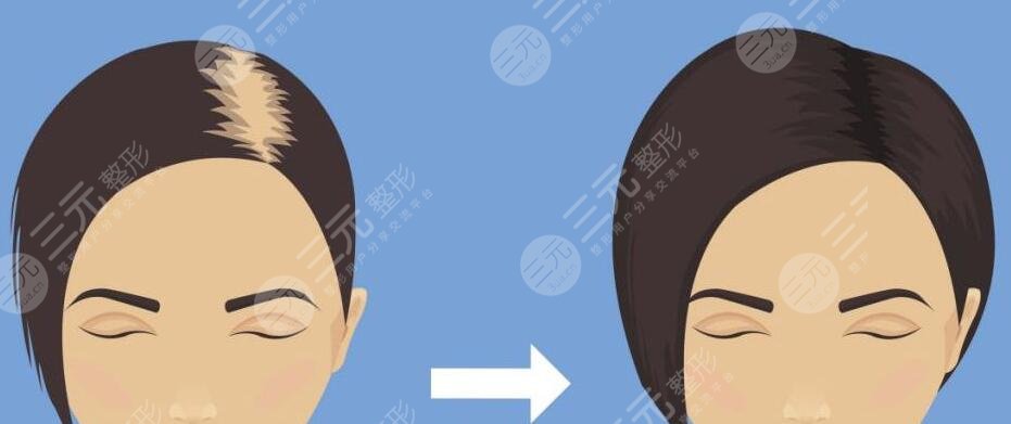 植發(fā)3000個(gè)毛囊價(jià)格是多少?