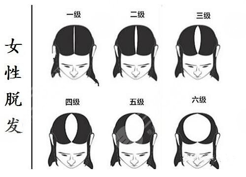 植發(fā)3000個(gè)毛囊價(jià)格是多少?