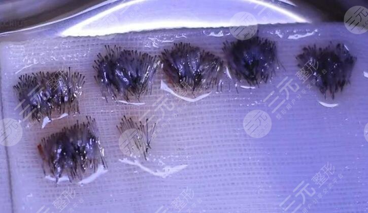 做完頭發(fā)種植手術(shù)后需要注意什么?