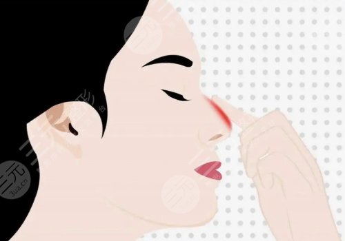 寶尼達(dá)隆鼻會(huì)變寬嗎？