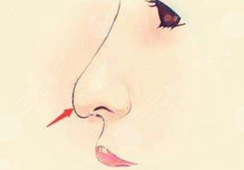 寶尼達(dá)隆鼻可以維持多久？