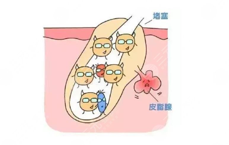 激光去痤瘡注意事項(xiàng)有哪些?