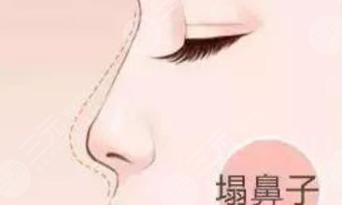 奧美定隆鼻有什么副作用？