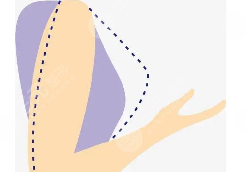 奧美定取出手術(shù)后要注意些什么？