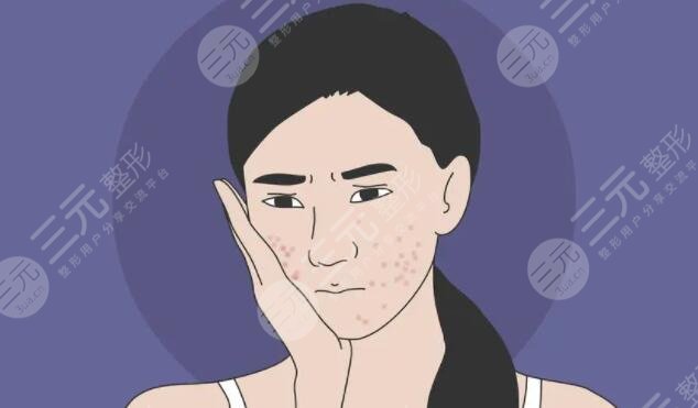 怎么快速祛痘痘印不傷膚又有效?