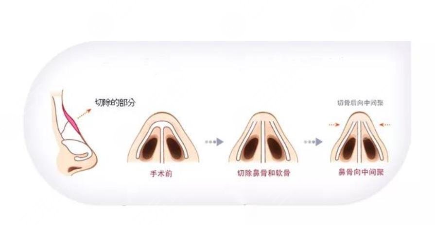 駝峰鼻手術一般多少錢?