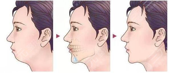 墊下巴手術(shù)的原理是什么呢?