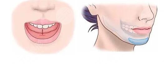 墊下巴多長時間恢復(fù)正常?