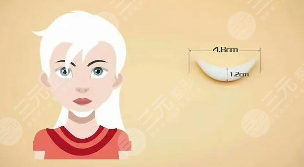 墊下巴多長時間恢復(fù)正常?