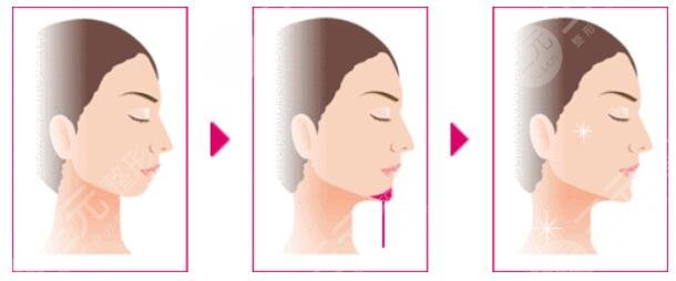 墊下巴手術(shù)的注意事項