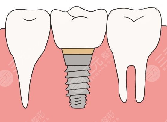 種牙材質(zhì)都有哪些品牌好？涉及韓國、瑞士、瑞典等國進口品牌，怎么比較？