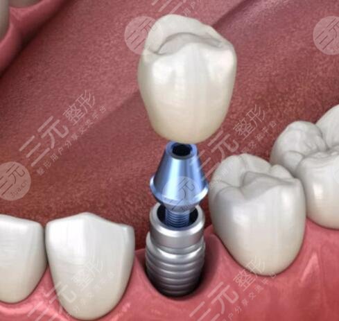 種植牙多少錢一顆?