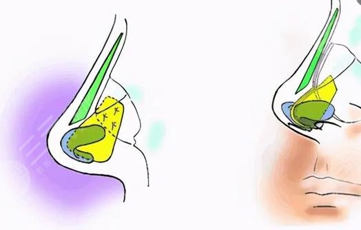 隆鼻有什么危害和后遺癥嗎？