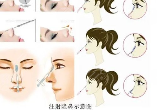 愛(ài)貝芙隆鼻會(huì)變寬嗎？