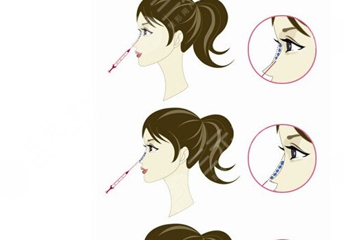 愛(ài)貝芙隆鼻會(huì)變寬嗎？