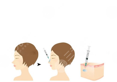 玻尿酸注射鼻頭紅腫和栓塞的區(qū)別是什么?