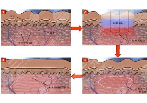 深藍(lán)射頻做一次有效果嗎？