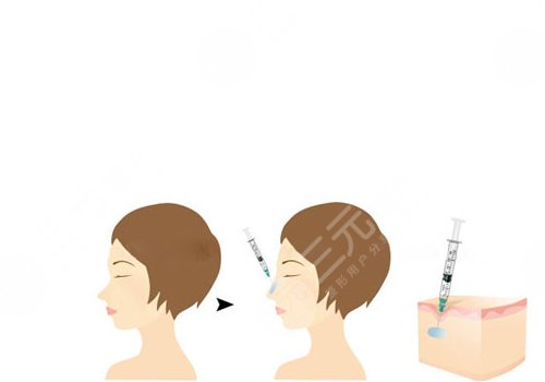 愛(ài)貝芙隆鼻會(huì)變寬嗎