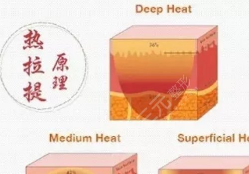 深藍(lán)射頻和熱拉提哪個(gè)好？