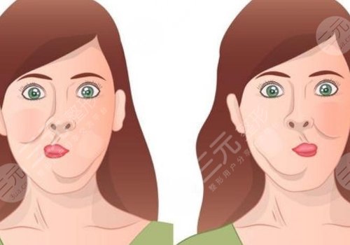 深藍(lán)射頻和熱拉提哪個(gè)好？