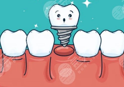 種植牙可以用社保卡報銷嗎？