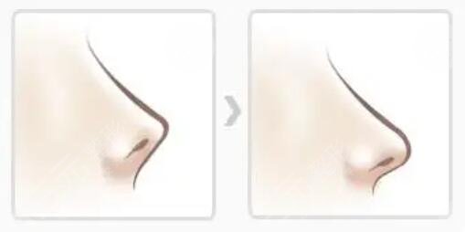 高順福和羅勇誰的技術(shù)好？2位名醫(yī)從技術(shù)、手術(shù)細(xì)節(jié)、審美傾向多方比拼~