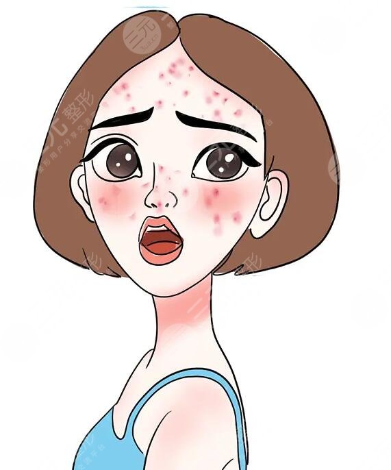 緩解青春痘方法