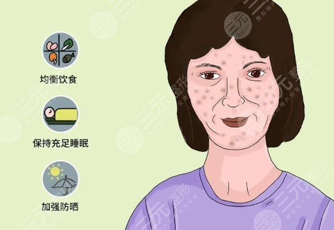 臉上黃褐斑怎么去掉好的方法小妙招