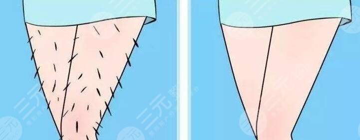 小腿激光脫毛的價(jià)格多少錢2023?