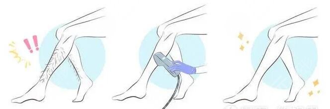 哪個(gè)季節(jié)適合激光脫毛?