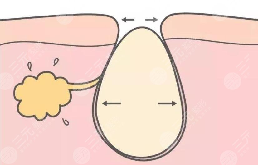 解讀！   激光緩解毛孔粗大