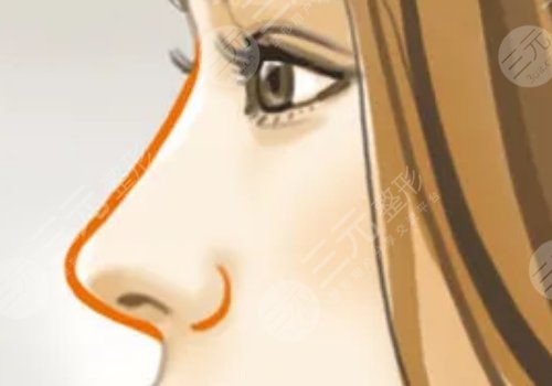 膠原蛋白隆鼻會(huì)變寬嗎？