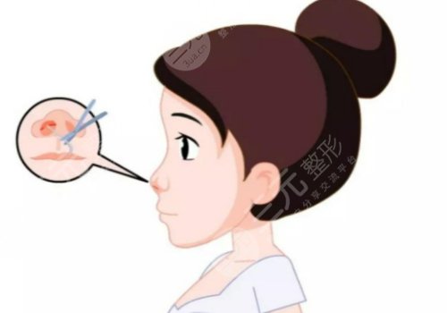 膠原蛋白隆鼻會(huì)變寬嗎？