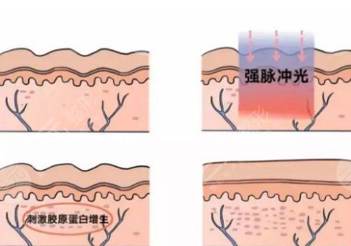 激光去疤痕需要幾次才能徹底消除？